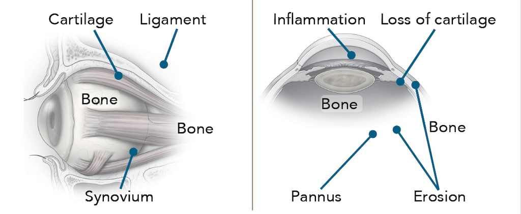 RA Joints Diagram