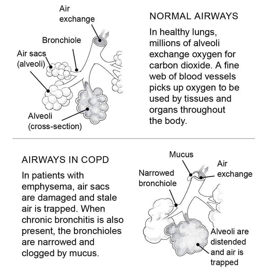 how copd affects the lungs