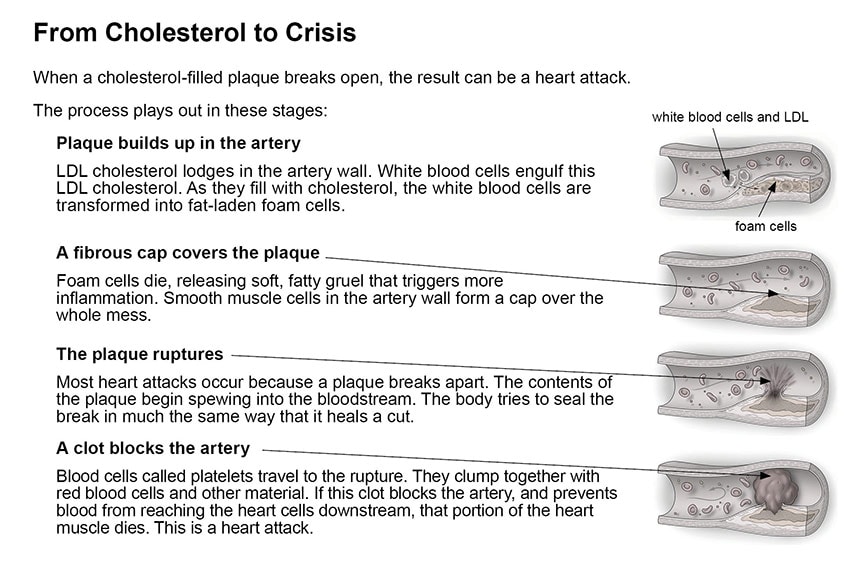 Cholesterol and cardiovascular disease