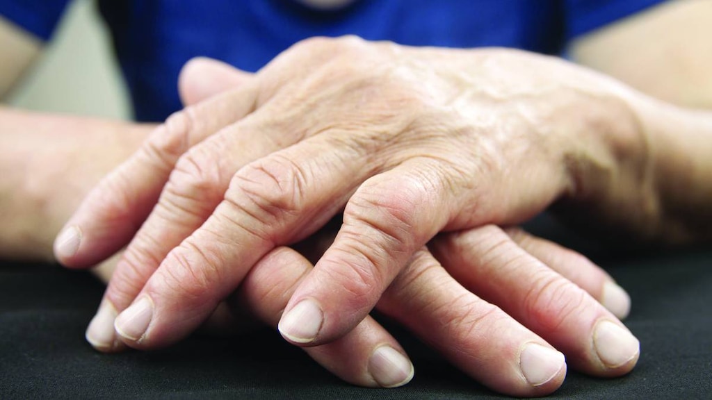 Woman's Deformed Hands from Arthritis