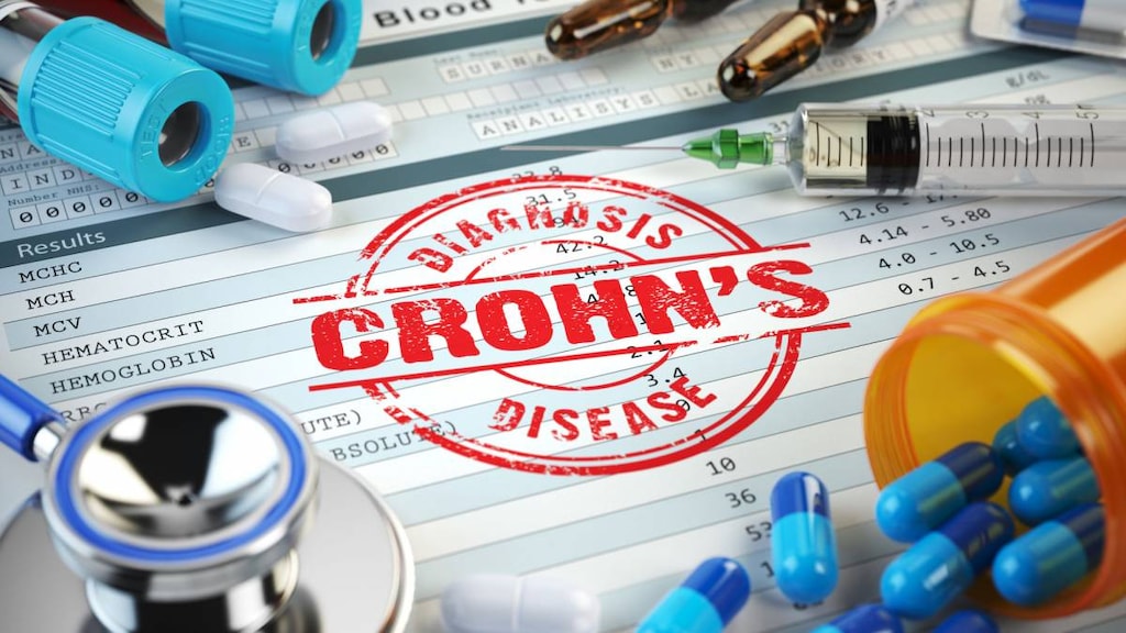 diagnosing crohn's disease