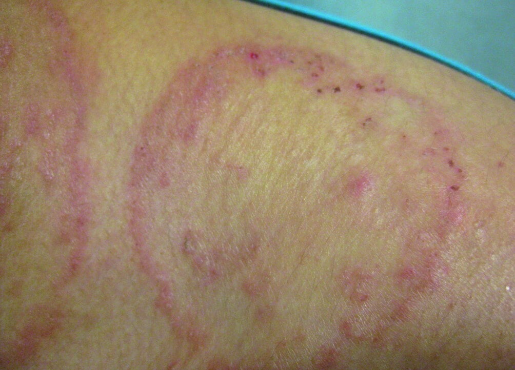 Body Ringworm (Tinea Corporis) - Skin Disorders - Medicine.com