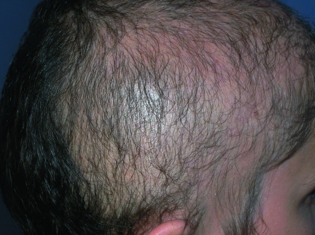 Alopecia (Hair Loss) - Skin Disorders - Medicine.com