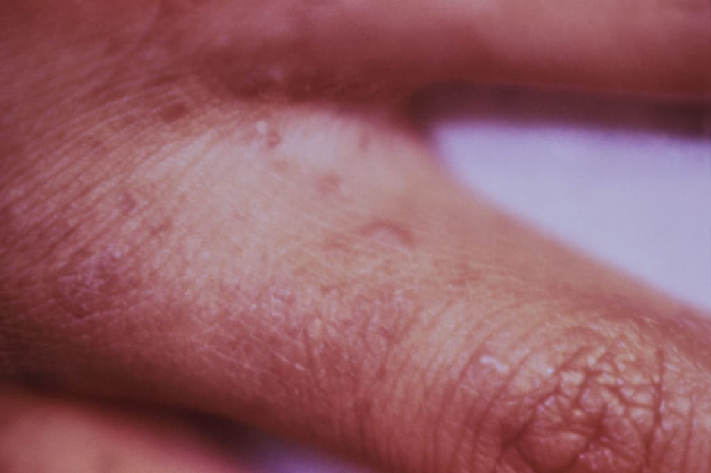 Scabies Infestation - Skin Disorders - Medicine.com