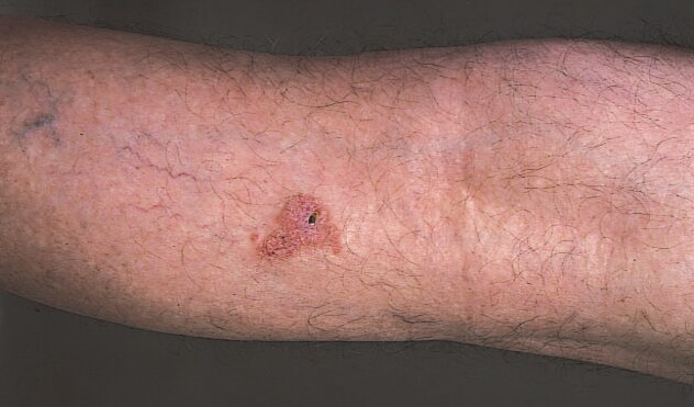 Skin Cancer Lesions On Arms