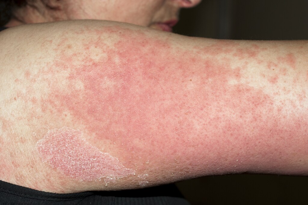 Drug Rashes Skin Disorders Medicine