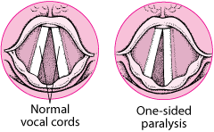 Vocal Cord Paralysis - Ear, Nose, and Throat Disorders - Medicine.com