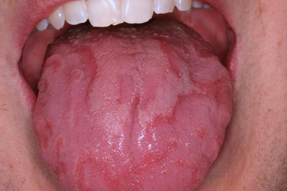 Tongue Discoloration and Other Changes - Mouth and Dental Disorders